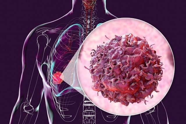 human body transparent skin showcasing lung cancer