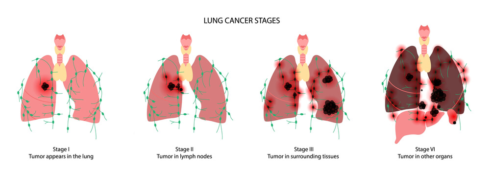 lung cancer stages
